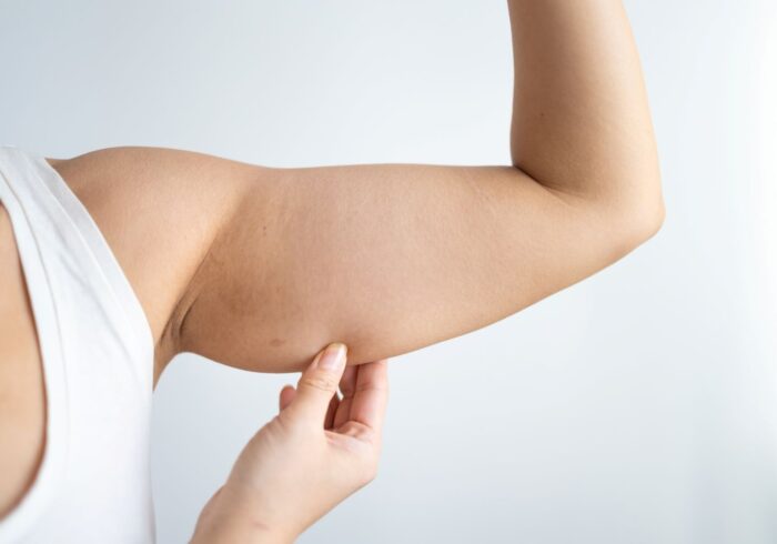 woman showing excess fat on arm